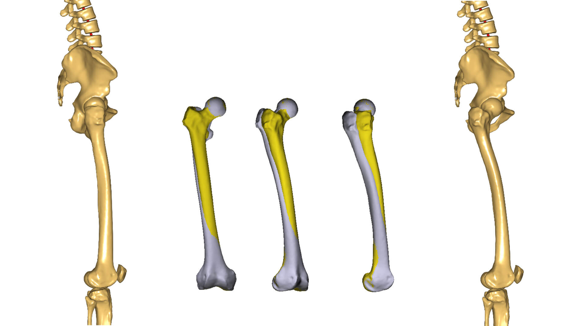 Modeling subject-specific femoral torsion for the analysis of lower-limb joint loads