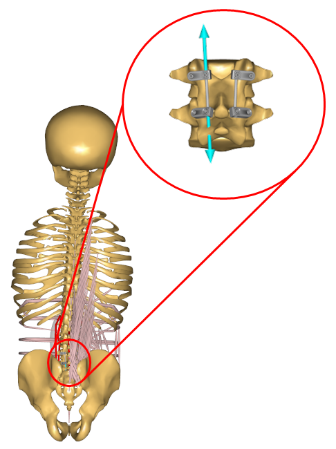 Spine fixation