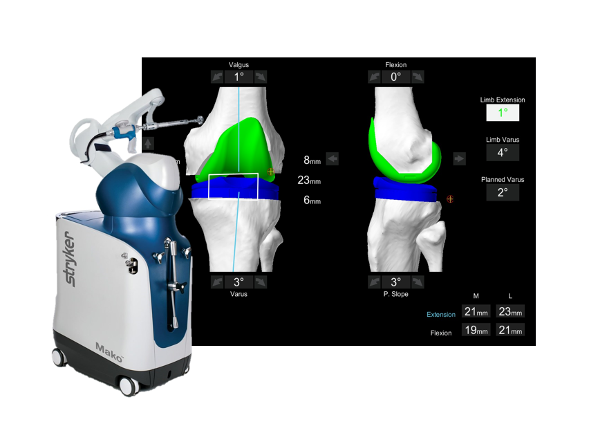 The future of personalized orthopedics: Kinematic modeling to restore the premorbid knee functionality through robotic-assisted TKA​
