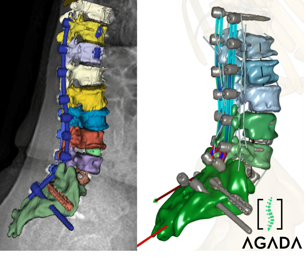 PatientSpecific Spine Analytics AnyBody Technology